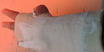 Fracture du cinquième métacarpien gauche et donc... 35 jours de plâtre !